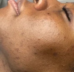 Dr Schrammek Green Herbal Peels at Ciuy Skin Clinic Leicester
