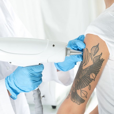 Laser tattoo removal at city laser and skin clinic leicester Laser tattoo removal at city laser and skin clinic leicester