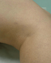 Laser thread vein removal at City Laser Clinic Leicester