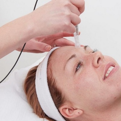microneedling at city laser and skin clinic leicester microneedling at city laser and skin clinic leicester