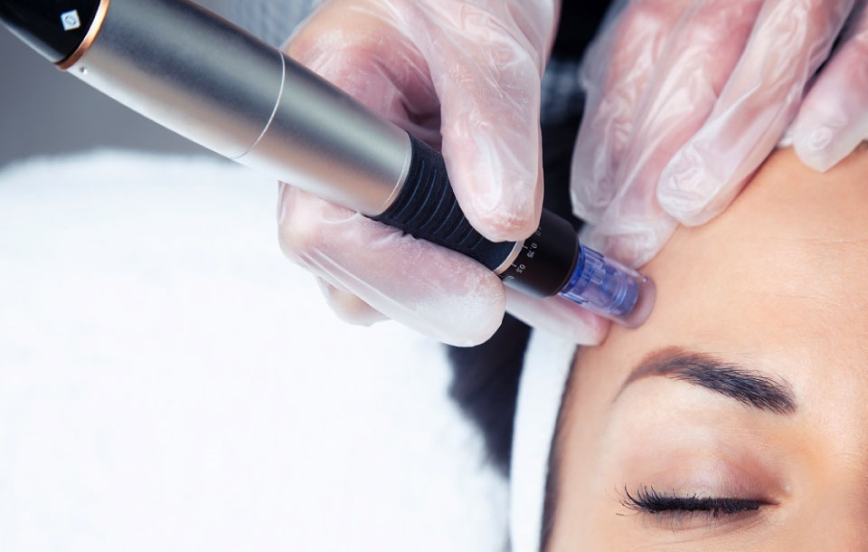 Transform Your Skin with Microneedling at Leicester's Top Skin Clinic