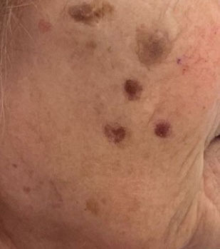 SEBORRHEIC KERATOSIS REMOVAL
