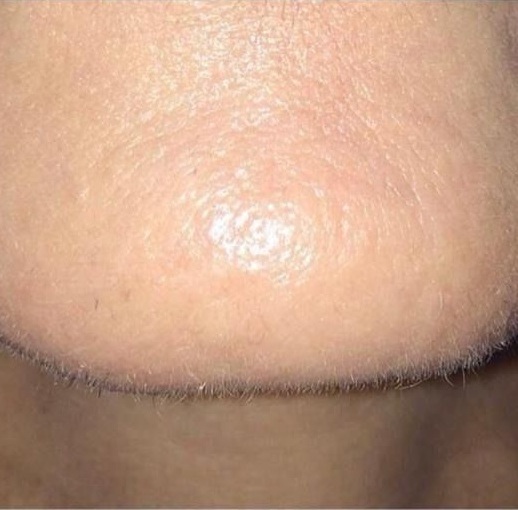 after electrolysis City Laser Skin Clinic in Leicester
