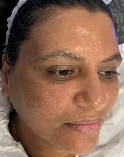 after hydrafacial at city skin clinic leicester