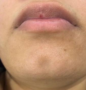 after laser hair removal at best clinic in leicester