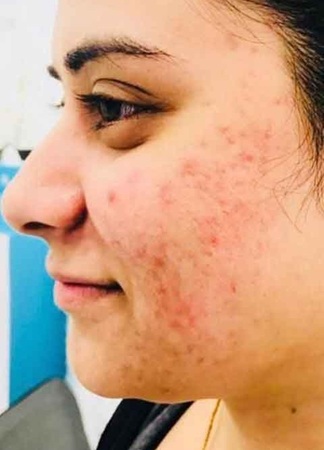 after medical microdermabrasion at top Leicester skin clinic