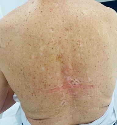 after seborrheic keratosis removal at best leicester skin clinic