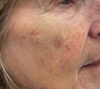 age spot removal at city skin clinic in leicester