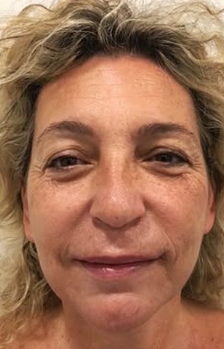 anti ageing radiofrequency treatments in leicester