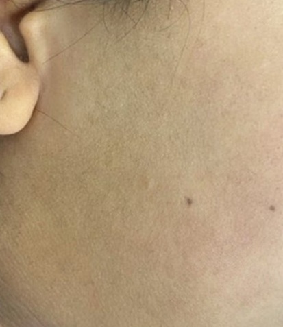 before and after laser hair removal at best beauty clinic in Leicester