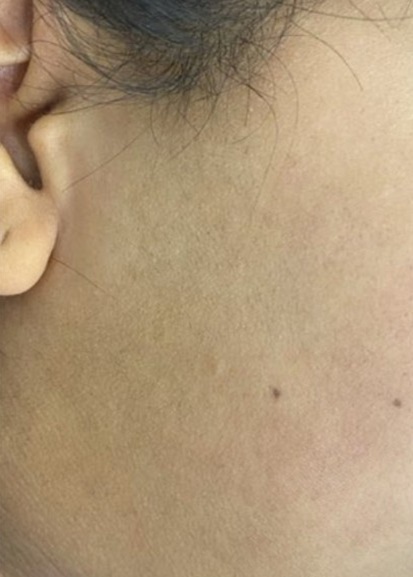 before and after laser hair removal at best beauty clinic in Leicester