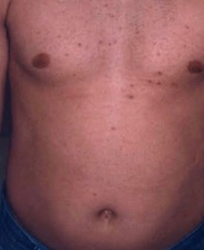 before and after laser hair removal at city laser clinic leicester