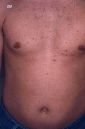 before and after laser hair removal at city laser clinic leicester