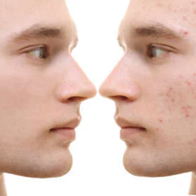clearer skin with microdermabrasion at City Skin Clinic Leicester clearer skin with microdermabrasion at City Skin Clinic Leicester