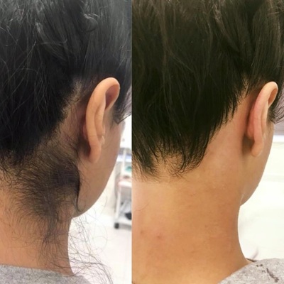 best laser hair removal clinic in leicester