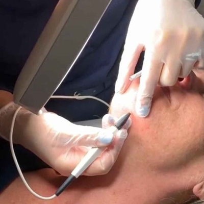 electrolysis hair removal in Leicester at City Skin Clinic