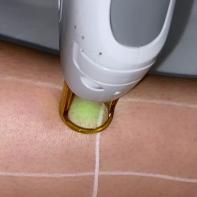 best laser hair removal clinic in leicester