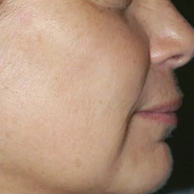laser age spot removal in leicester after