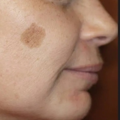 laser age spot removal in leicester before