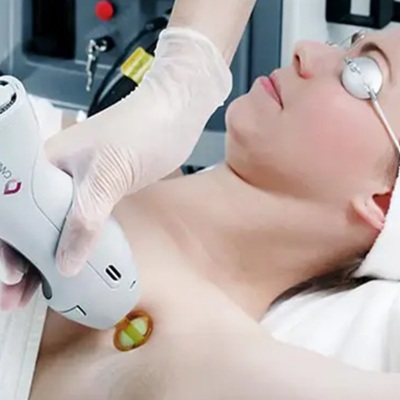 Women's laser hair removal in leicester