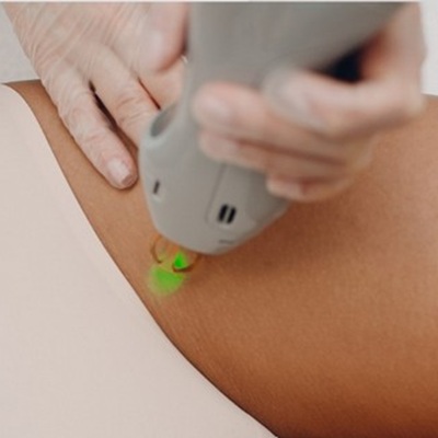 best laser hair removal clinic in leicester