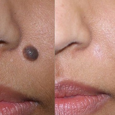 Laser mole removal at city laser and skin clinic leicester Laser mole removal at city laser and skin clinic leicester