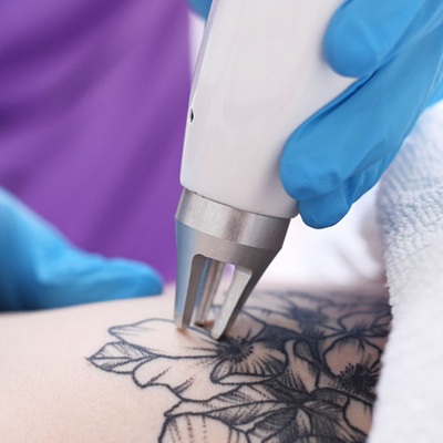 best laser tattoo removal clinic in leicester best laser tattoo removal clinic in leicester