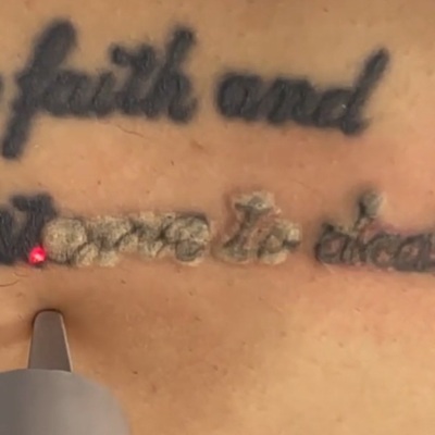 best laser tattoo removal clinic in leicester best laser tattoo removal clinic in leicester