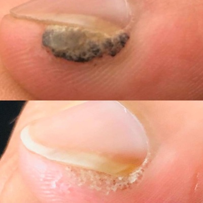 laser wart removal at leicester city skin clinic