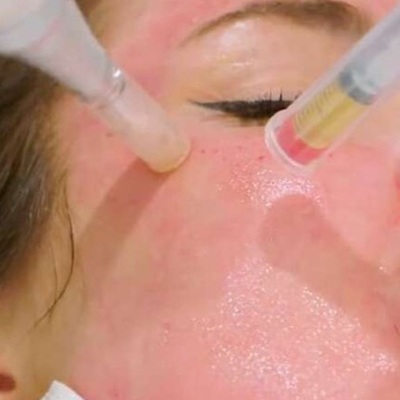 EDS Dermastamp Microneedling at Best Skin Clinic in Leicester EDS Dermastamp Microneedling at Best Skin Clinic in Leicester