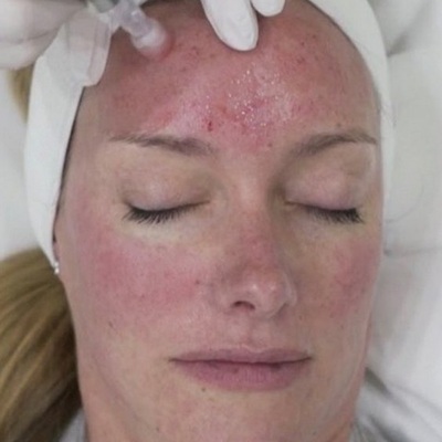 EDS Dermastamp Microneedling at Best Skin Clinic in Leicester EDS Dermastamp Microneedling at Best Skin Clinic in Leicester