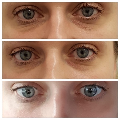 Reduce eye bags with pressotherapy at City Skin Clinic Leicester