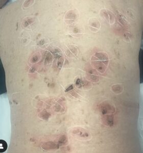 seborrheic keratosis removal at best leicester skin clinic