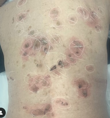 How To Remove Seborrheic Keratosis How To Remove Seborrheic Keratosis