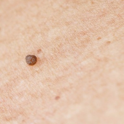 electrolysis skin tag removal in Leicester at City Skin Clinic electrolysis skin tag removal in Leicester at City Skin Clinic