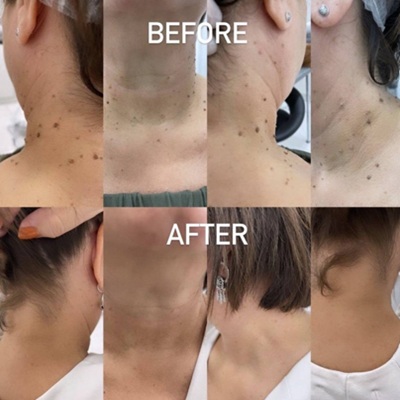 electrolysis skin tag removal in Leicester at City Skin Clinic electrolysis skin tag removal in Leicester at City Skin Clinic