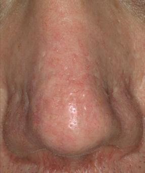 thread vein removal treatments at best clinic in Leicester