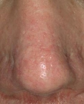 Best laser thread vein removal in Leicester