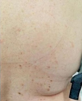 seborrheic keratosis removal at City Laser Clinic Leicester Copy