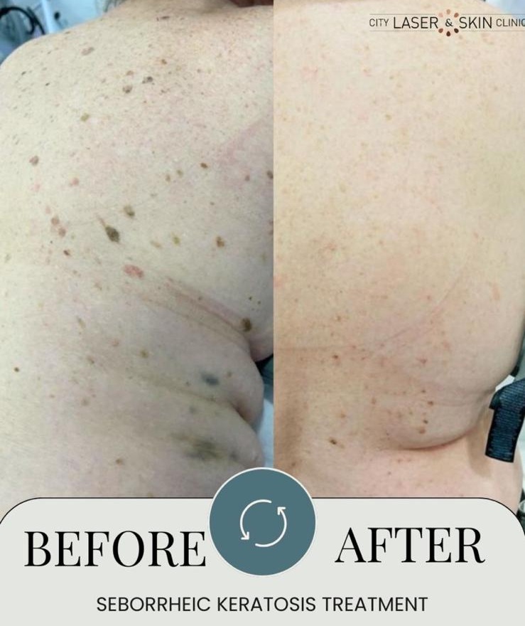 Seborrhoeic Keratosis removal at City Laser Clinic Leicester