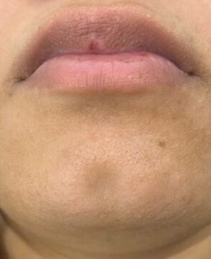 laser hair removal near me in leicester