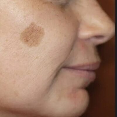 Seborrheic Keratosis vs Melanoma