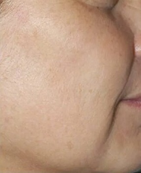 seborrheic keratosis laser treatments leicester